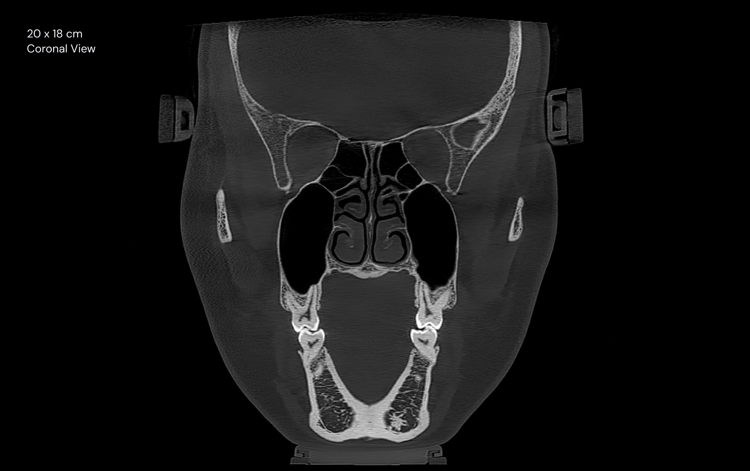20 x 18 cm Coronal View